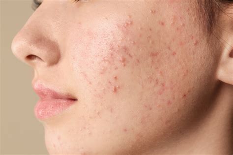 Top Causes of Skin Blemishes