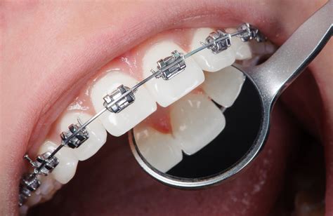 Traditional Braces: Effective and Well-Known