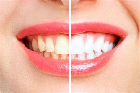 Transform Your Smile: The Power of a Flawless Set of Pearly Whites