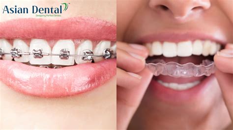 Transparent Teeth Appliances: Braces vs Aligners