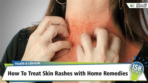 Treatment Options and Remedies for Rashes on the Lower Limbs