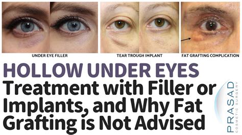 Treatment Options for Hollowed-Out Eyes: From Lifestyle Changes to Medical Procedures