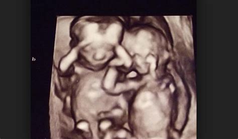 Twin Ultrasound: A Glimpse inside the Womb