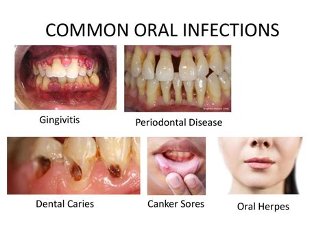 Types of Oral Infections and Their Characteristics