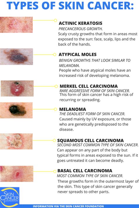 Types of Skin Cancer: Differentiating Melanoma, Basal Cell Carcinoma, and Squamous Cell Carcinoma