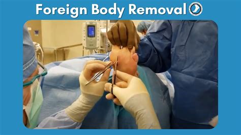 Unbelievable Medical Cases: Surgically Removing Foreign Objects