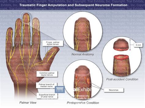 Uncovering the Concealed Significances in Finger Amputation Dreams