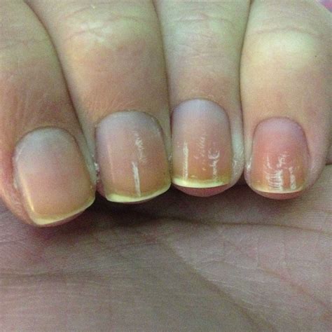 Uncovering the Hidden Meanings of Nightmares Involving Damaged Nails