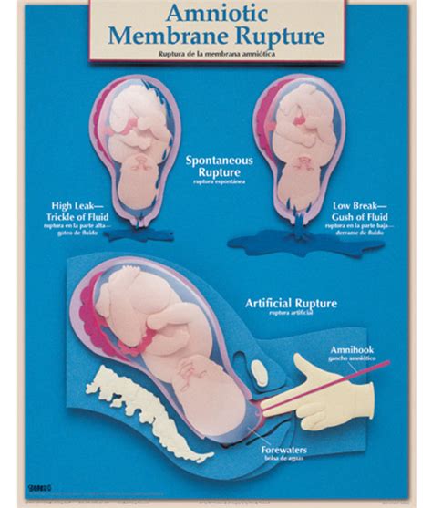 Uncovering the Medical Explanation of Rupture of Amniotic Membranes