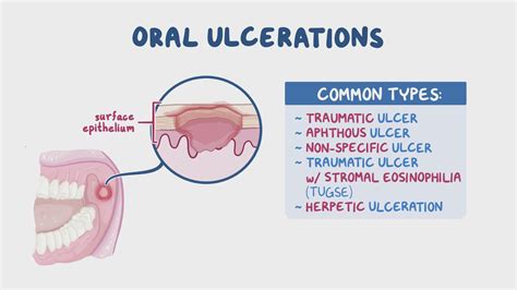 Uncovering the Root Causes of Oral Ulcers