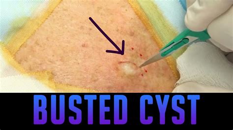 Uncovering the Science behind Cysts and their Removals