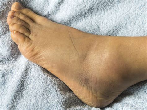 Uncovering the Underlying Factors of Foot Swelling: Looking Beyond the Obvious