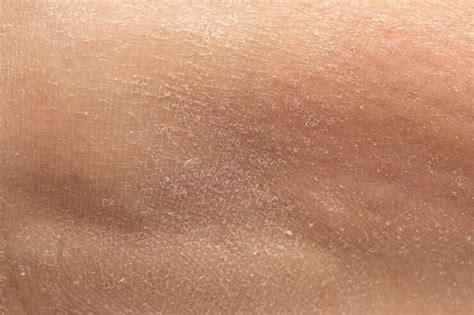 Understanding Dead Skin: Why Does It Occur?