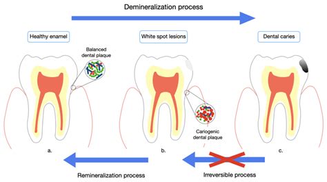 Understanding Dental Decay: Factors Contributing to Tooth Deterioration