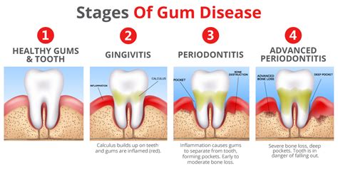 Understanding Mouth Abscess: What Leads to its Development?