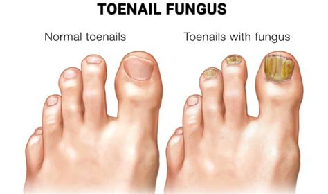 Understanding Nail Fungus: Causes and Symptoms