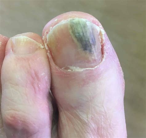 Understanding Onychomycosis: What Is It and How It Develops