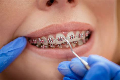 Understanding Orthodontic Treatment: What You Should Know