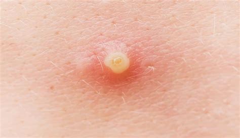 Understanding Pus Pimples: What They Are and Why They Occur