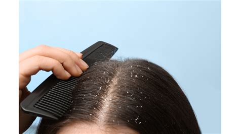 Understanding Scalp Peeling: An Overview