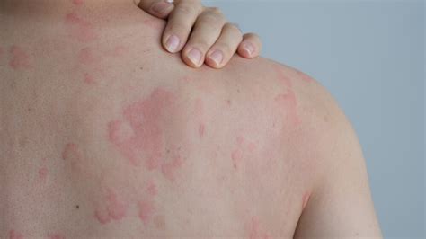 Understanding Skin Hives: A Brief Overview