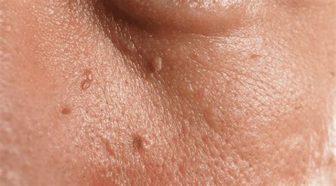 Understanding Skin Tags: What are They and Why Do They Appear?