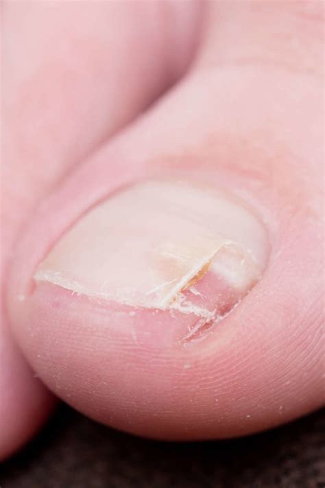 Understanding Split Nails: Causes and Symptoms