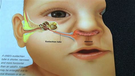 Understanding Swelling in the Ears of Children: Key Information for Concerned Parents