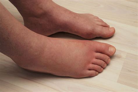 Understanding Swollen Toes: What You Should Know