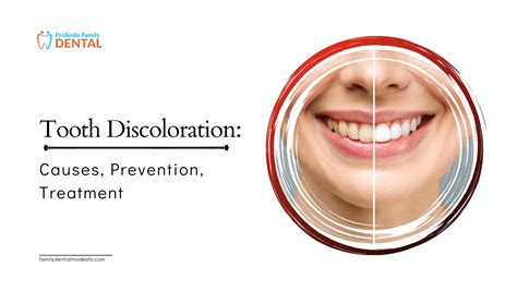 Understanding Teeth Discoloration: Causes and Treatments