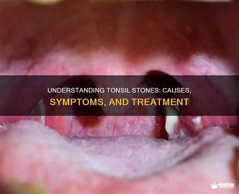 Understanding Tonsil Stones: Definition, Symptoms, and Prevalence