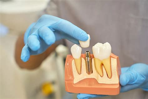 Understanding Tooth Implants: Exploring their Function and Mechanism