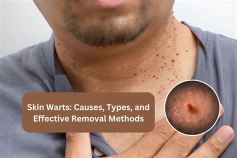 Understanding Warts: Causes and Symptoms