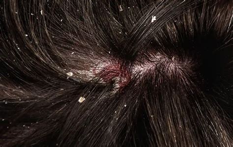 Understanding the Causes, Recognizing the Symptoms, and Exploring the Treatment Options for Flaky Scalp