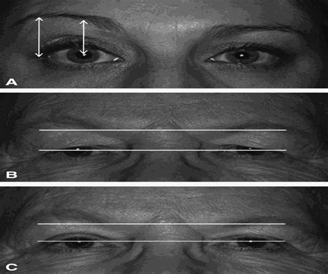 Understanding the Causes of Asymmetric Eyebrows