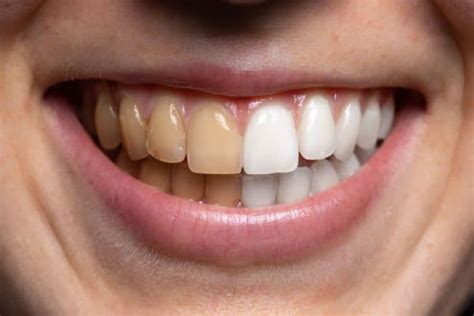 Understanding the Culprits behind Tooth Discoloration