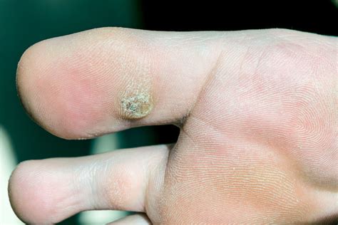 Understanding the Development of Warts on Toes: Exploring their Nature and Formation