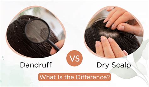 Understanding the Distinction: Scalp Peeling vs. Dandruff