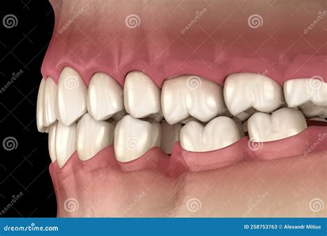 Understanding the Emotional Impact of Losing Molar Teeth in Dreams