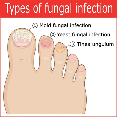 Understanding the Factors behind Toe Nail Fissures: Reasons, Indications, and Management