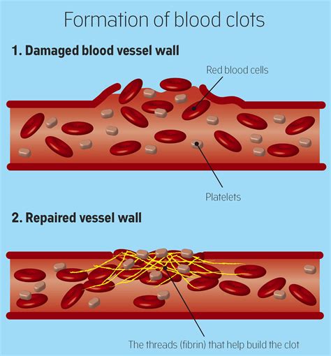 Understanding the Formation of Blood Clots