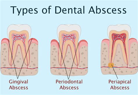 Understanding the Fundamentals of Dental Abscesses