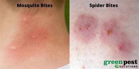 Understanding the Hidden Messages: Spider Bite on the Chest