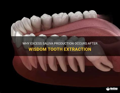 Understanding the Issue: Overabundance of Saliva Production