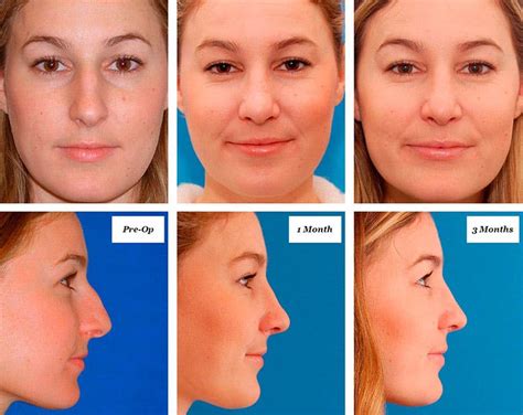 Understanding the Life-changing Potential of Rhinoplasty