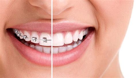 Understanding the Link Between Orthodontic Treatment and Self-Perception