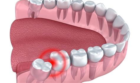 Understanding the Meaning and Origins of Dental Misalignment: Unraveling the Enigma behind Crooked Teeth