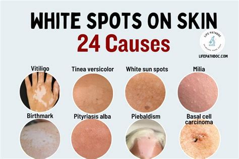 Understanding the Meaning of Pale Patches on the Skin