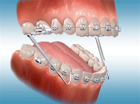 Understanding the Mechanics: How Orthodontic Appliances Work to Align Teeth