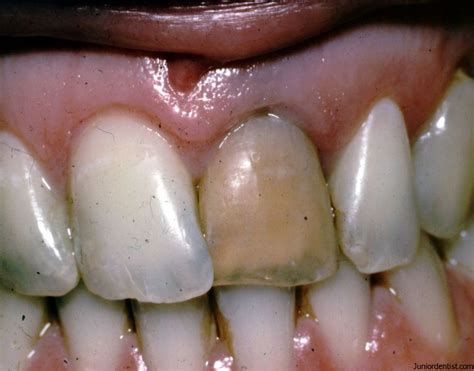 Understanding the Origins and Indicators of Tooth Loss with Dark Coloration in Dreams